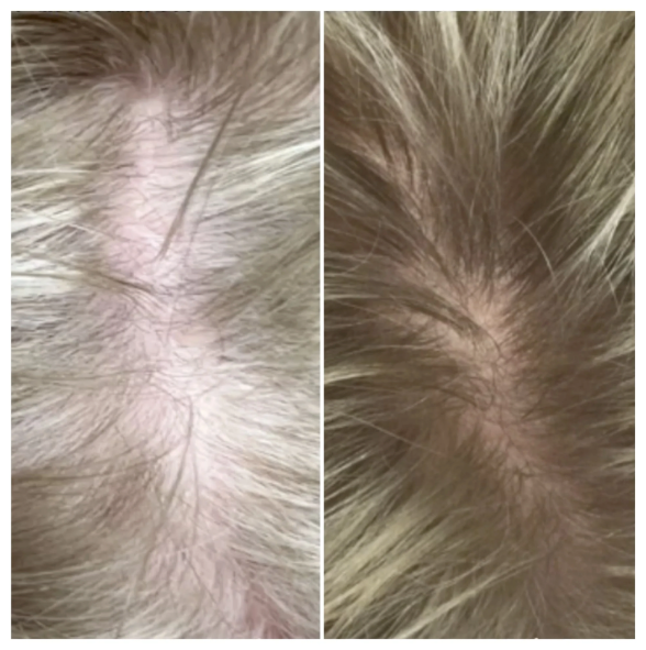 Haaruitval bij vrouwen: wat maakt het anders?