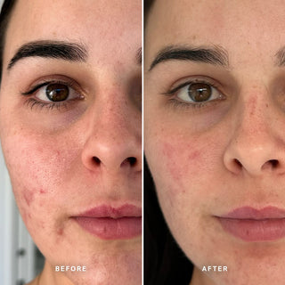 Alpha-H Clear Skin Tonic résultat avant et après trois