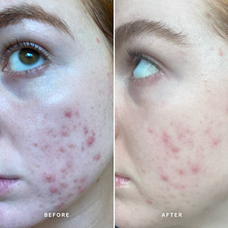 Alpha-H Clear Skin Tonic résultat avant et après deux