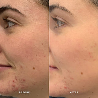 Alpha-H Clear Skin Tonic résultat avant et après quatre