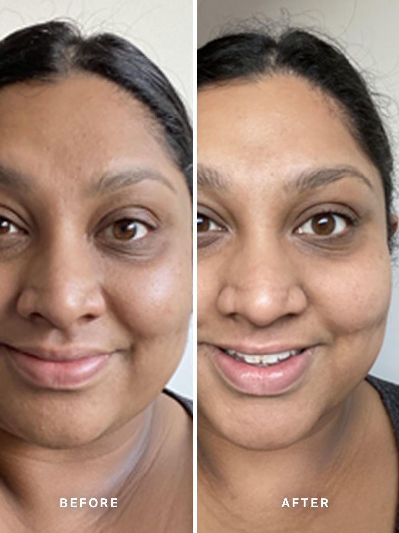 Alpha-H Liquid Gold Exfoliating Treatment avant et après résultat quatre