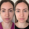 Alpha-H Vitamin B Serum avant et après résultat